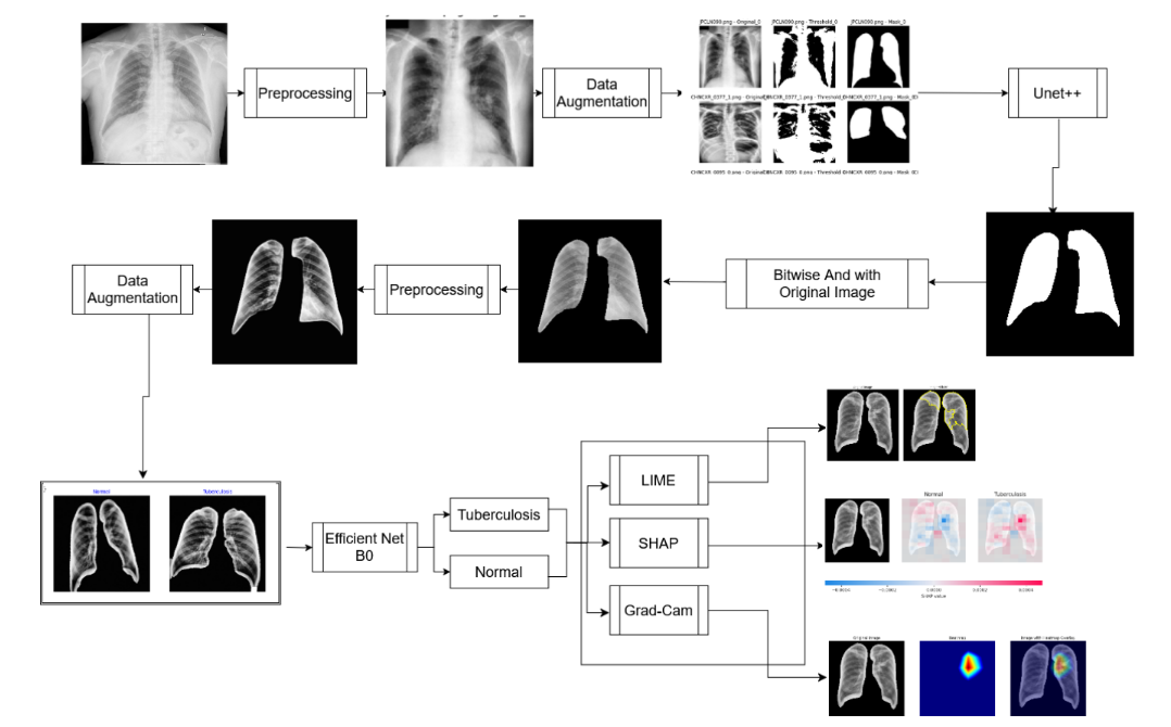 Tuberculosis Detection